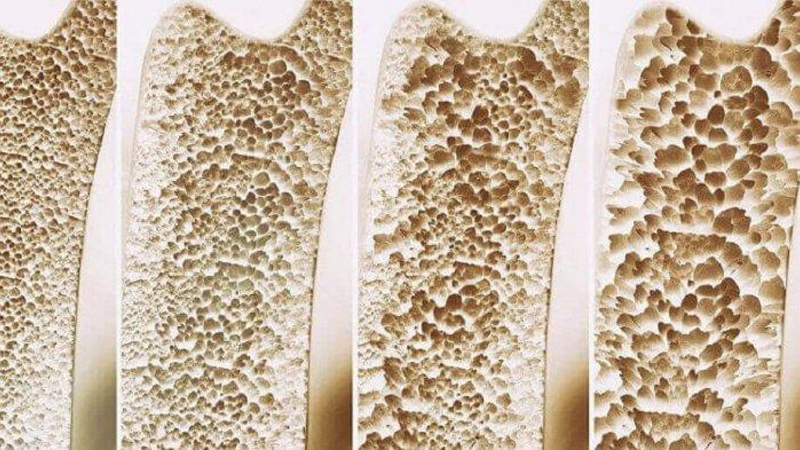 Osteoporosis – Nutrisi dan Pencegahan dari PAFI Manado